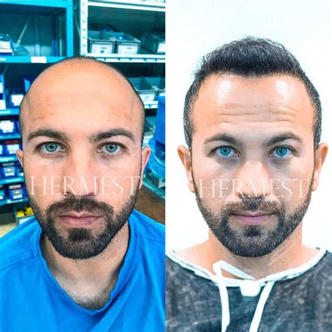 haartransplantation türkei hermest